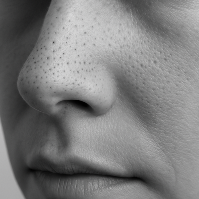 Blackheads